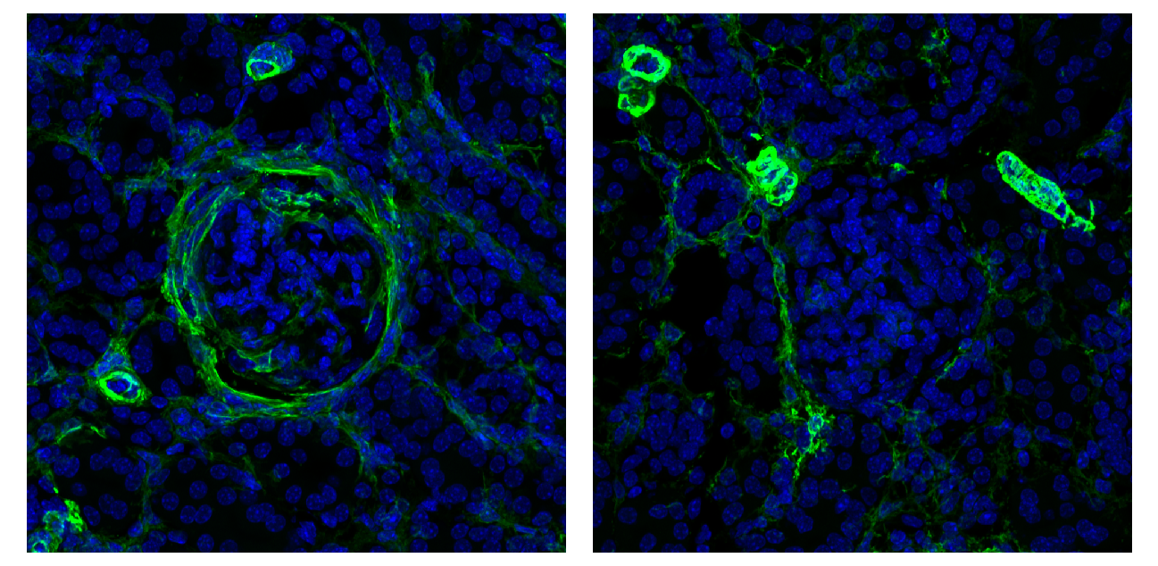 Kidney tissue (lupus mouse model) showing signs of incipient fibrosis (green). When the NKp46 receptor of the ILCs is blocked (right), the lupus nephritis recedes. Blue: cell nuclei.  © Charité | Frauke Schreiber